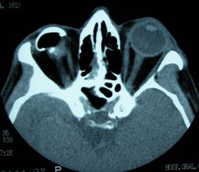 Anophthalmic cavity 2