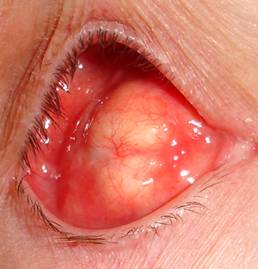 Anophthalmic cavity 3