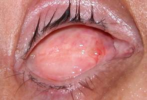 Anophthalmic cavity 6