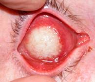 Anophthalmic cavity 7