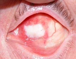 Anophthalmic cavity 8