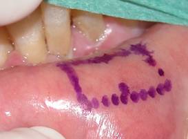 Anophthalmic cavity 9