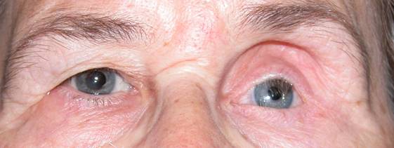 Anophthalmic cavity 13