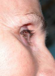 Anophthalmic cavity 14