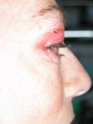 Anophthalmic cavity 15