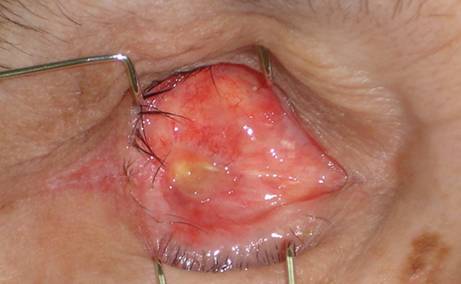 Anophthalmic cavity 16