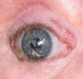 Anophthalmic cavity 17