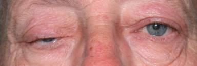 Anophthalmic cavity 18