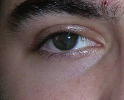 Anophthalmic cavity 21