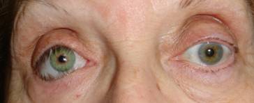 Anophthalmic cavity 22