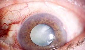 Cataracts 1