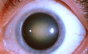 Cataracts 2