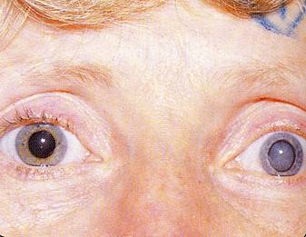 Cataracts 3