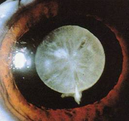 Cataracts 8
