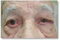 Ectropion 9