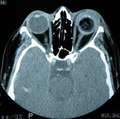 Enucleation Evisceration  Exenteration 7