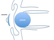 Enucleation Evisceration  Exenteration 10
