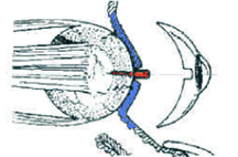 Enucleation Evisceration  Exenteration 11
