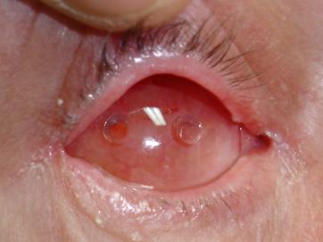 Enucleation Evisceration  Exenteration 12