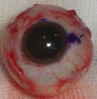 Enucleation Evisceration  Exenteration 14
