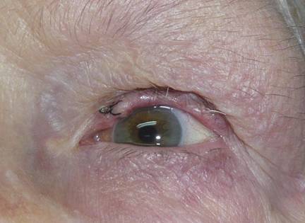Entropion 8