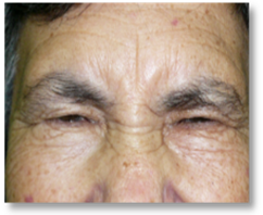 Blefarospasmo 1