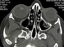 Orbital fractures 4
