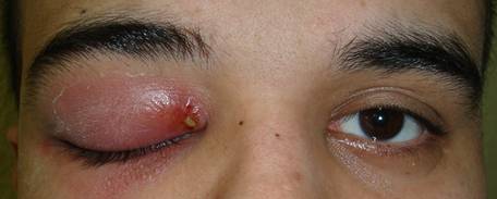 Orbital inflammation 1