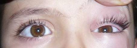 Orbital inflammation 4