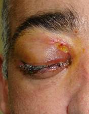 Orbital inflammation 5
