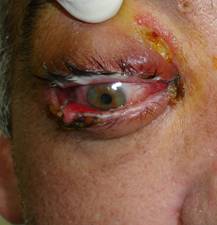 Orbital inflammation 6