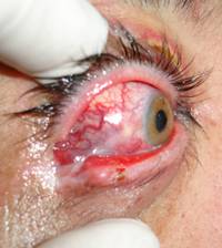 Orbital inflammation 7