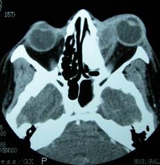 Orbital inflammation 8