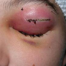 Orbital inflammation 9