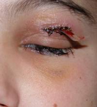 Orbital inflammation 10