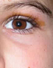 Orbital inflammation 11