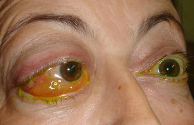 Orbital inflammation 12