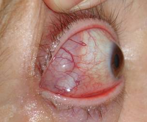 Orbital inflammation 13