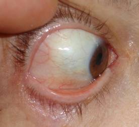 Orbital inflammation 14