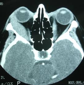 Orbital inflammation 15