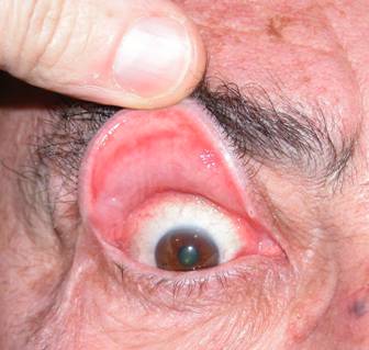 Eyelid hyperlaxity 1