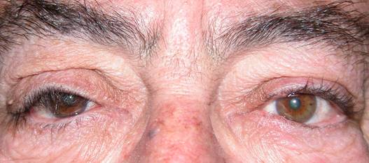 Eyelid hyperlaxity 2