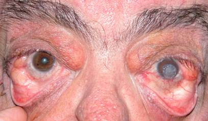 Eyelid hyperlaxity 4