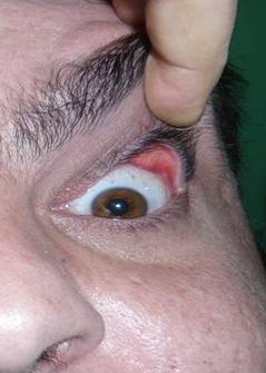 Eyelid hyperlaxity 7