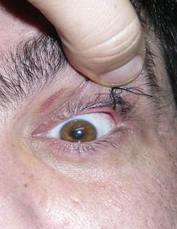 Eyelid hyperlaxity 8