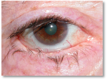 Eyelash malposition1