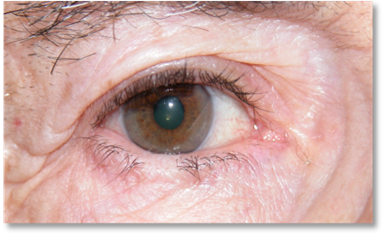 Eyelash malposition2