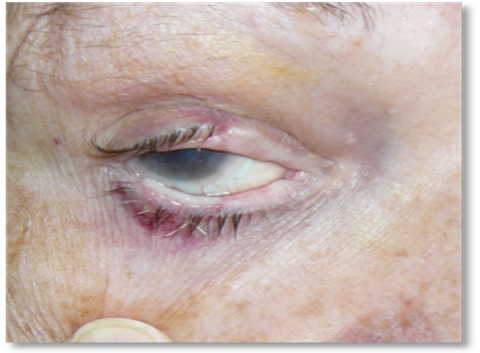 Eyelash malposition3