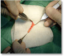 Eyelash malposition5