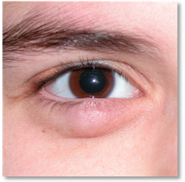 Stye Chalazion 1